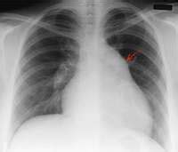 pulmoner hipertansiyon akciğer grafisi